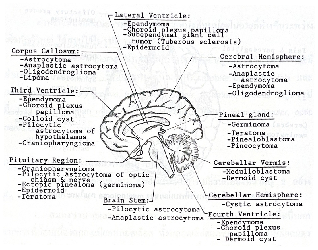 แผนภาพตำแหน่งเนื้องอกสมองในเด็ก พร้อมรายชื่อเนื้องอกตามบริเวณต่าง ๆ