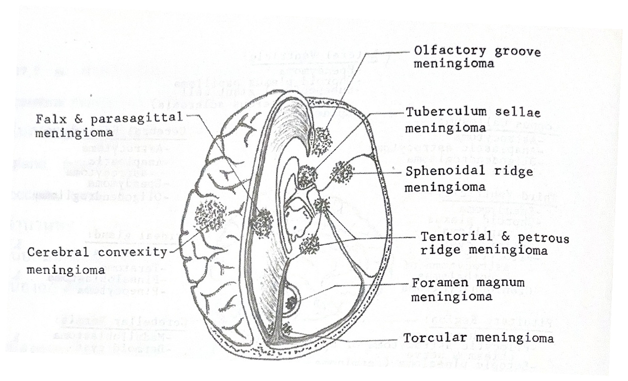 ตำแหน่ง meningioma ได้แก่ falx และ parasagittal, cerebral convexity, olfactory groove, tuberculum sellae, sphenoidal ridge, tentorial และ petrous ridge, foramen magnum และ torcular