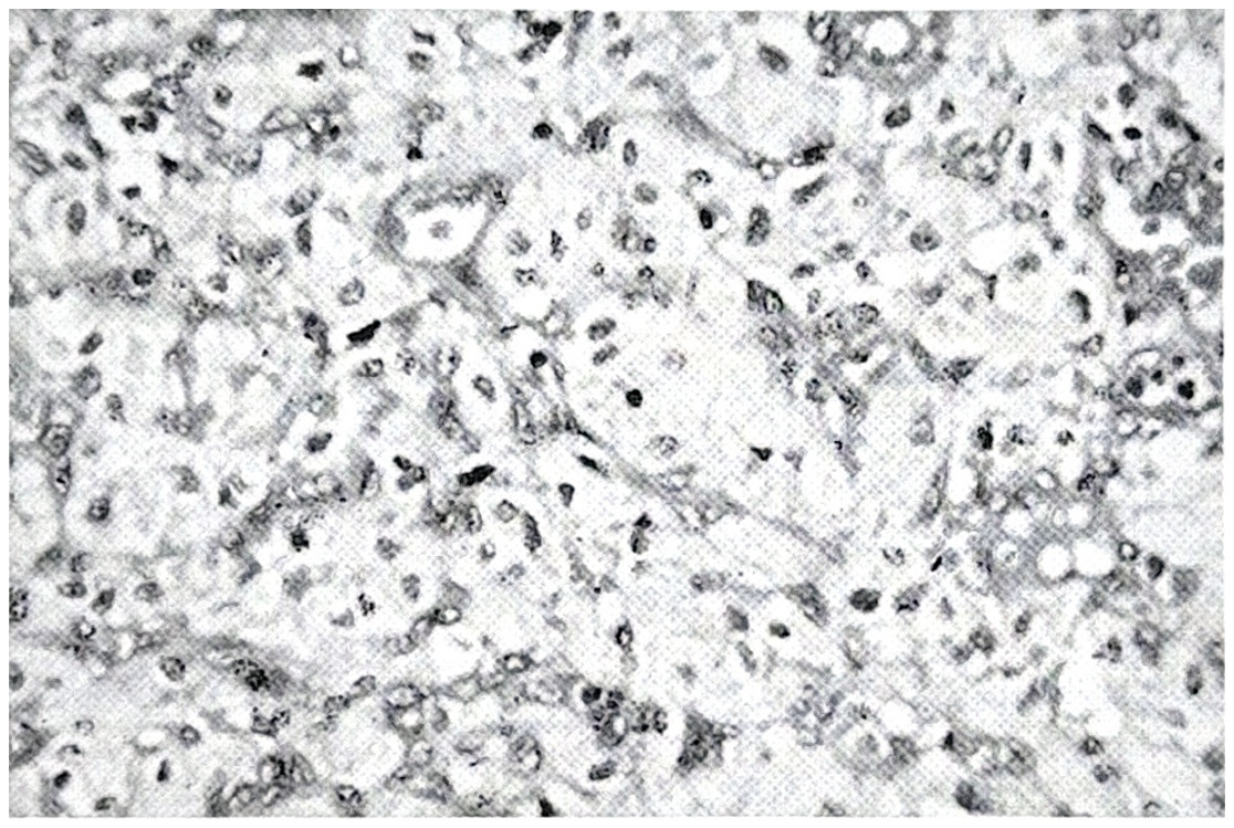 รูปที่ 3.100 ก. แสดงถึง hemangioblastoma ประกอบด้วยหลอดเลือดผนังบางมากมาย มี endothelial cells รูปร่างผอม stromal cells มีรูปร่างกลมใหญ่ nucleus ติดสีเข้ม และบางตัวมีลักษณะ foamy cytoplasm
