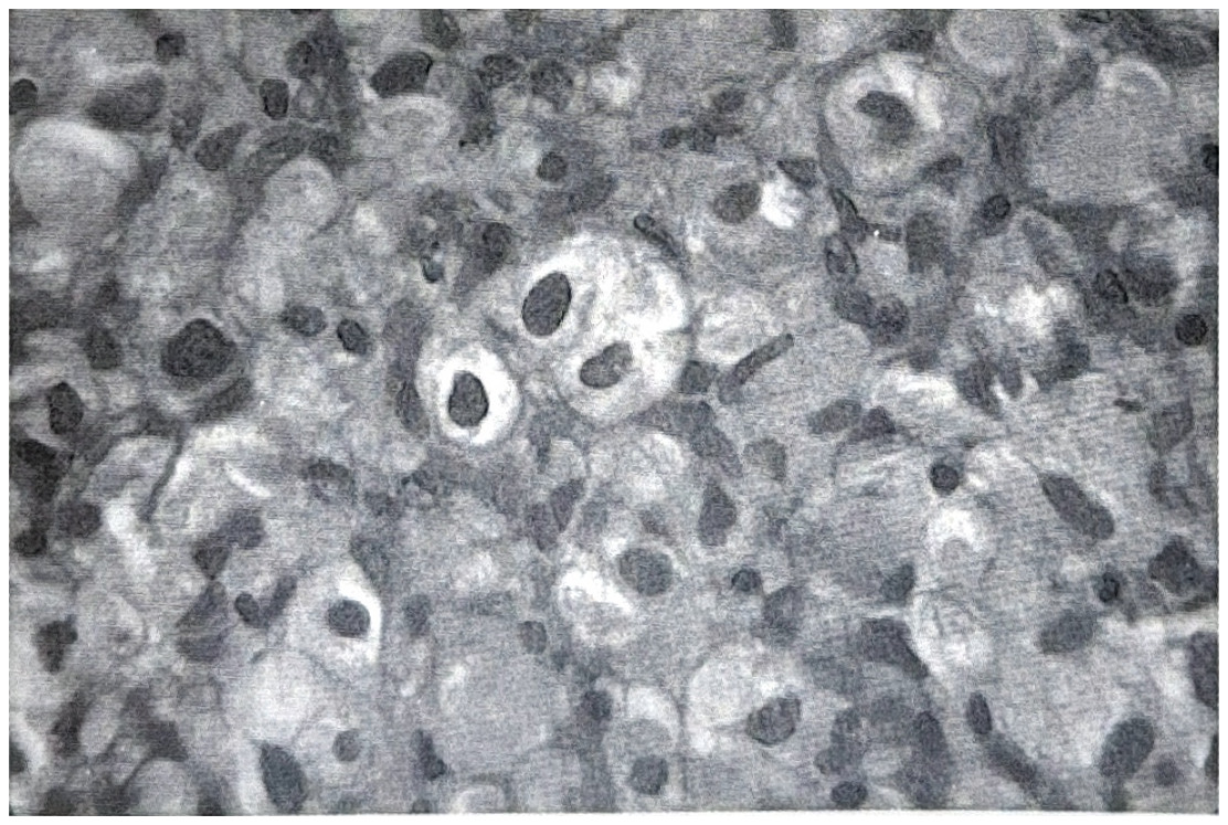 รูปที่ 3.100 ข. ภาพขยาย high power เห็นเซลล์มีลักษณะ foamy cytoplasm