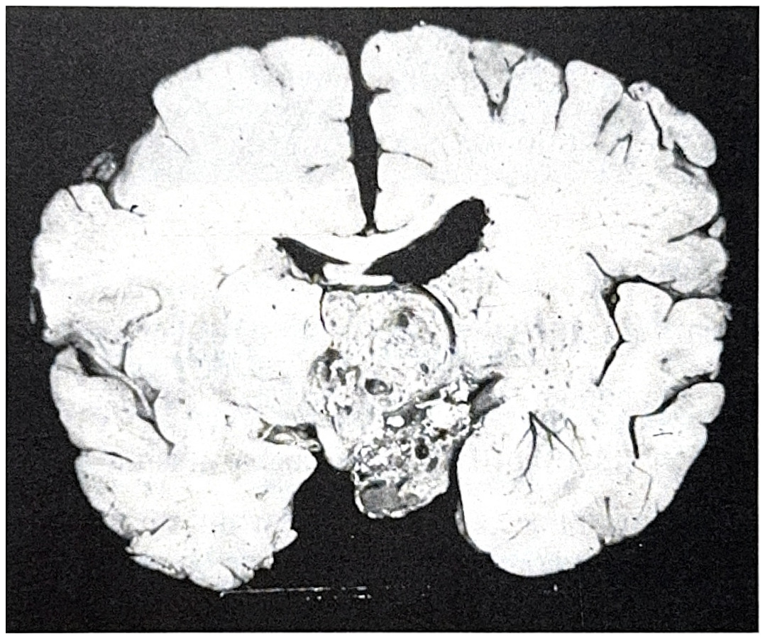 รูปที่ 3.101 แสดงถึง craniopharyngioma บริเวณ suprasellar ขยายตัวเข้าสู่ 3rd ventricle และอุดตัน foramen of Monro