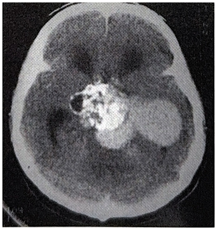 รูปที่ 3.102 แสดงให้เห็น craniopharyngioma ขยายตัวใหญ่ในบริเวณ temporal lobe และ clivus สังเกตเห็น cyst หลายแห่งที่เนื้องอกตรง suprasellar