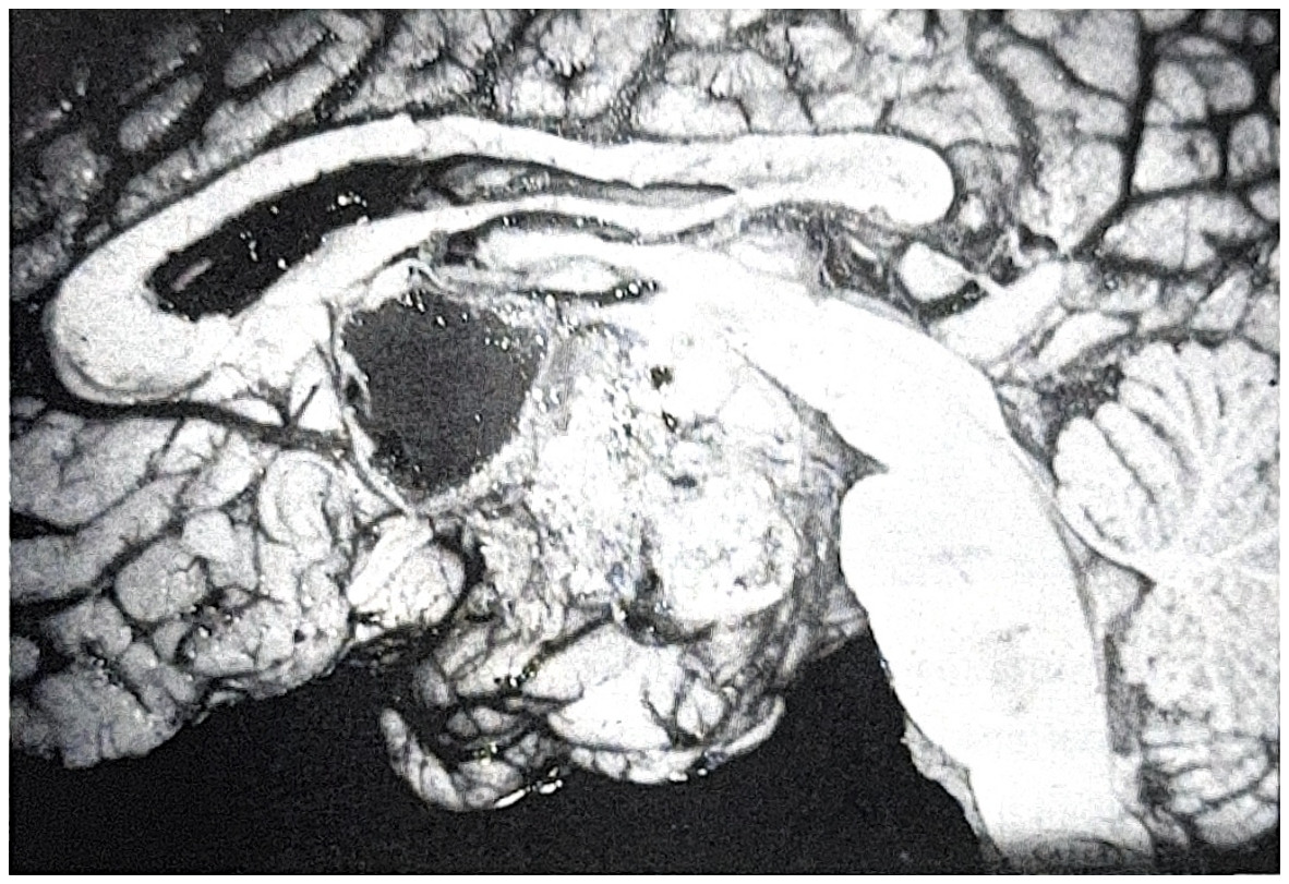 รูปที่ 3.103 ภาพสมองตัดตามแนวกลาง แสดงให้เห็น craniopharyngioma ขนาดใหญ่ ผิวหน้าตัดไม่เรียบมีหินปูนอยู่เป็นหย่อม เห็น cyst ขนาดโต น้ำภายในมีสีน้ำตาลและมีเกล็ด cholesterol สีทอง