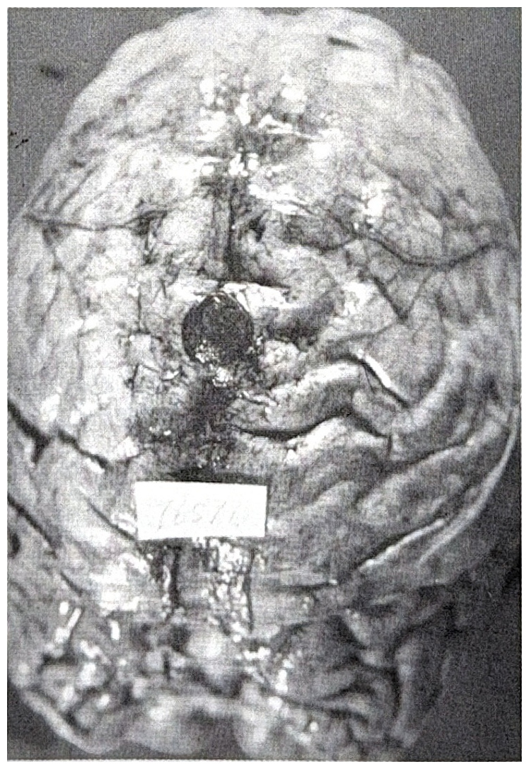 รูปที่ 3.128 แสดงให้เห็น metastatic tumor เกิดขึ้นที่ epidural space
