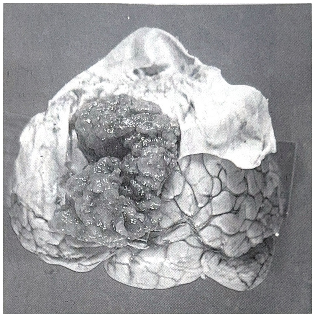 รูปที่ 3.129 แสดงถึง metastatic tumor ขนาดใหญ่ที่ epidural space บริเวณ fronto-parietal lobe เนื้องอกมีผิวขรุขระ และมีสีเขียวเหมือนสีน้ำดี ผลการตรวจเนื้อเป็น hepatoma