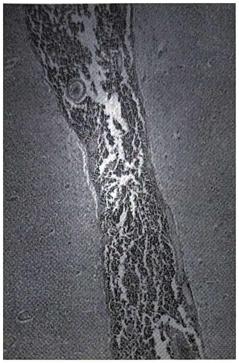รูปที่ 3.130 แสดงให้เห็น เซลล์มะเร็งกระจายอยู่ใน subarachnoid space อย่างแน่นหนา