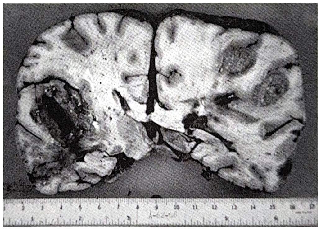 รูปที่ 3.131 แสดงให้เห็น metastatic brain tumor มีตำแหน่งที่เกิดอยู่ตรงรอยต่อระหว่าง white และ grey matter สังเกตเห็นเนื้องอกมีอยู่หลายแห่ง ซึ่งเป็นลักษณะสำคัญที่ใช้ในการวินิจฉัยโรค