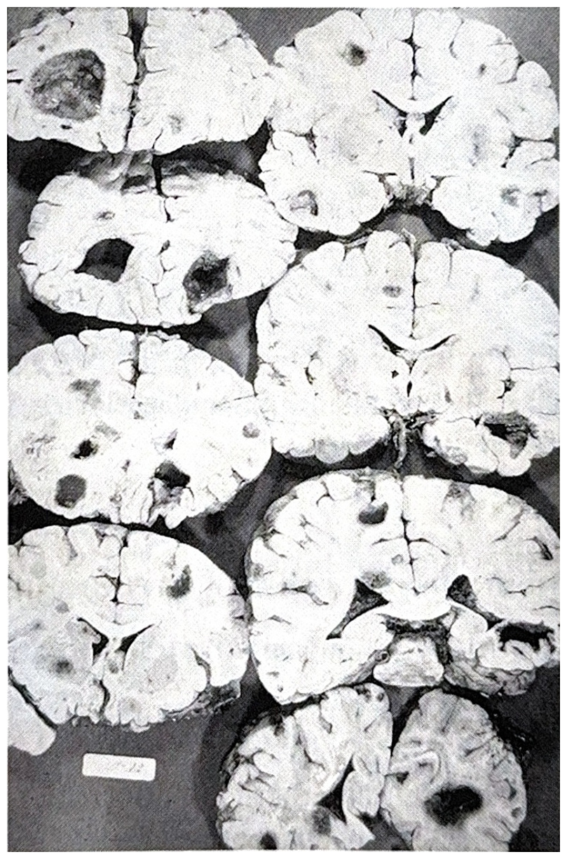 รูปที่ 3.132 แสดงให้เห็น metastatic brain tumor ที่เกิดขึ้นในสมองหลายแห่ง มีขนาดต่าง ๆ กัน ซึ่งเป็นลักษณะสำคัญที่ใช้วินิจฉัยโรค สังเกตเนื้องอกมีทั้งที่เป็น ก้อนทึบ, cyst และที่มีเลือดออก