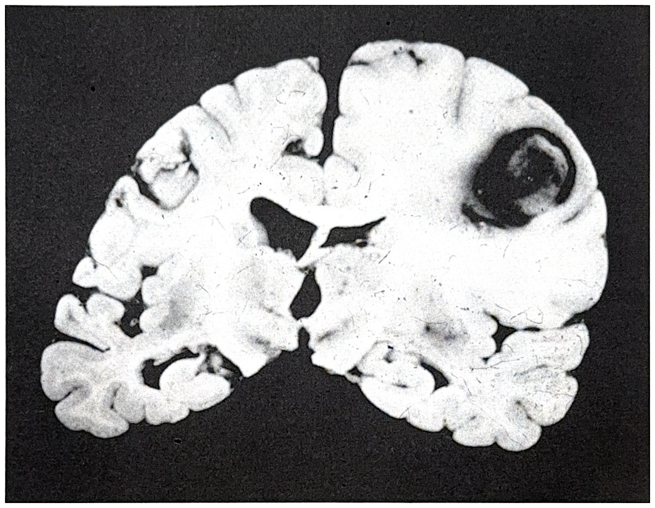 รูปที่ 3.133 แสดงถึง metastatic brain tumor ที่มีลักษณะสมองบวมรอบ ๆ เนื้องอกมาก โดยไม่มีความสัมพันธ์กับขนาดของก้อน