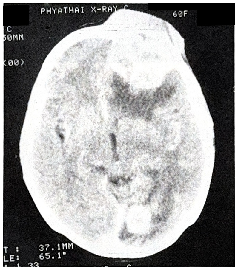 รูปที่ 3.134 แสดงถึง metastatic brain tumor มีการทำลายทั้งสมอง dura mater และกะโหลกศีรษะ สังเกตเห็นเนื้องอกอีกแห่งหนึ่งที่ occipital lobe ผู้ป่วยรายนี้เป็นมะเร็งเต้านม