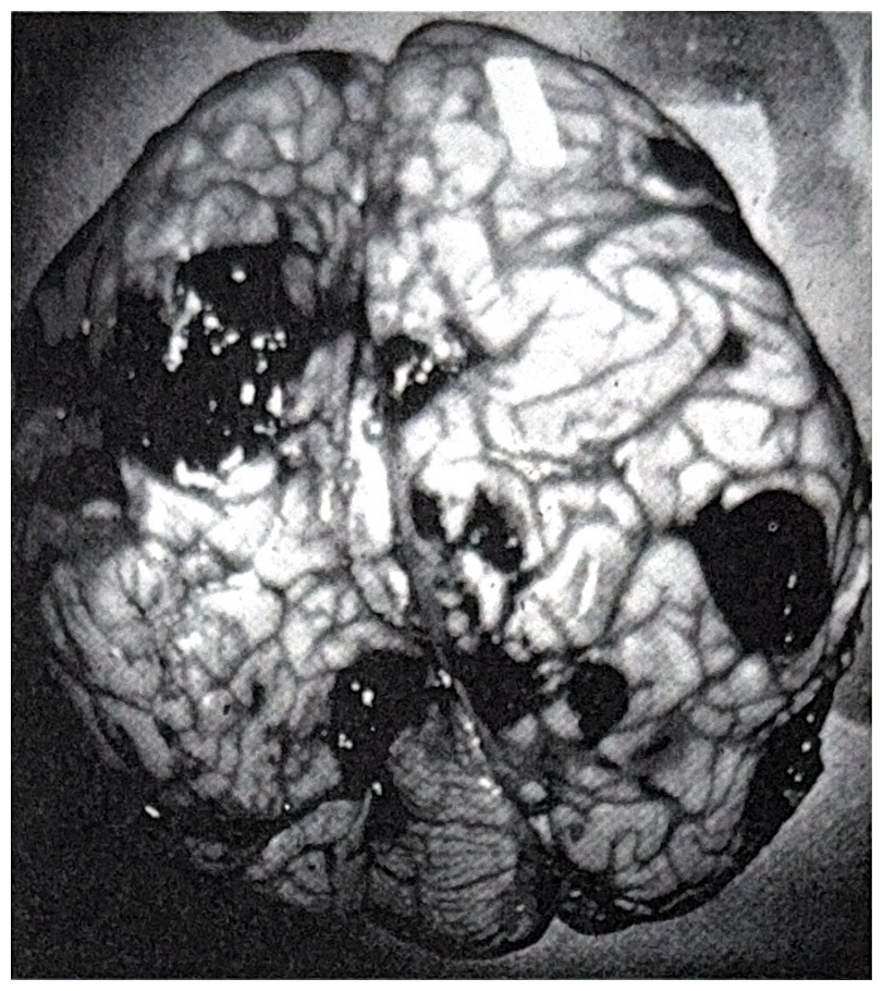 รูปที่ 3.135 แสดงถึง metastatic malignant melanoma ที่สมอง จะสังเกตเห็นเนื้องอกมีสีดำเกิดขึ้นอยู่หลาย ๆ แห่ง