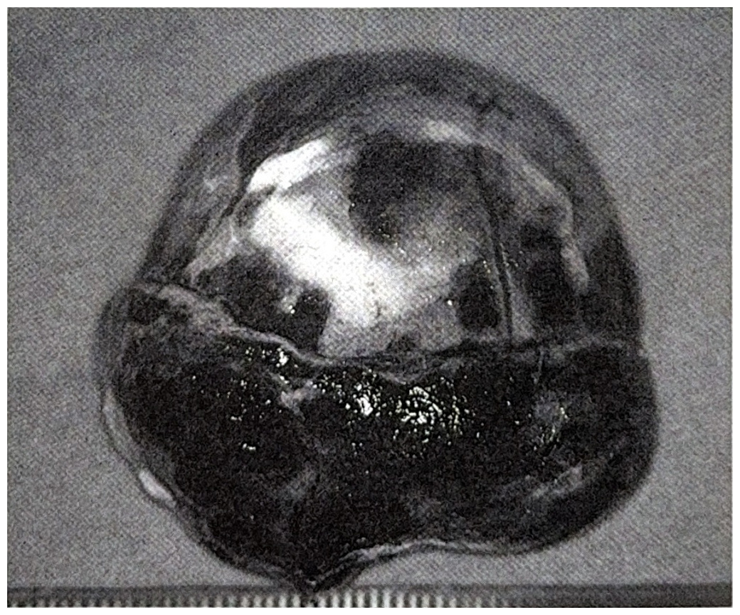 รูปที่ 3.136 ภาพชิ้นเนื้อจากการผ่าตัด แสดงให้เห็นก้อนเนื้อ malignant melanoma มีสีดำขอบเขตชัดเจน