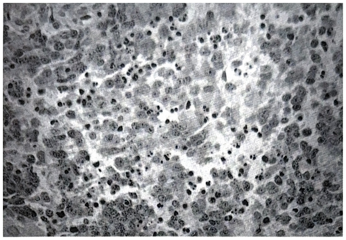 รูปที่ 3.137 แสดงถึง malignant melanoma สังเกตเห็น melanin pigment ใน cytoplasm และมี mitosis