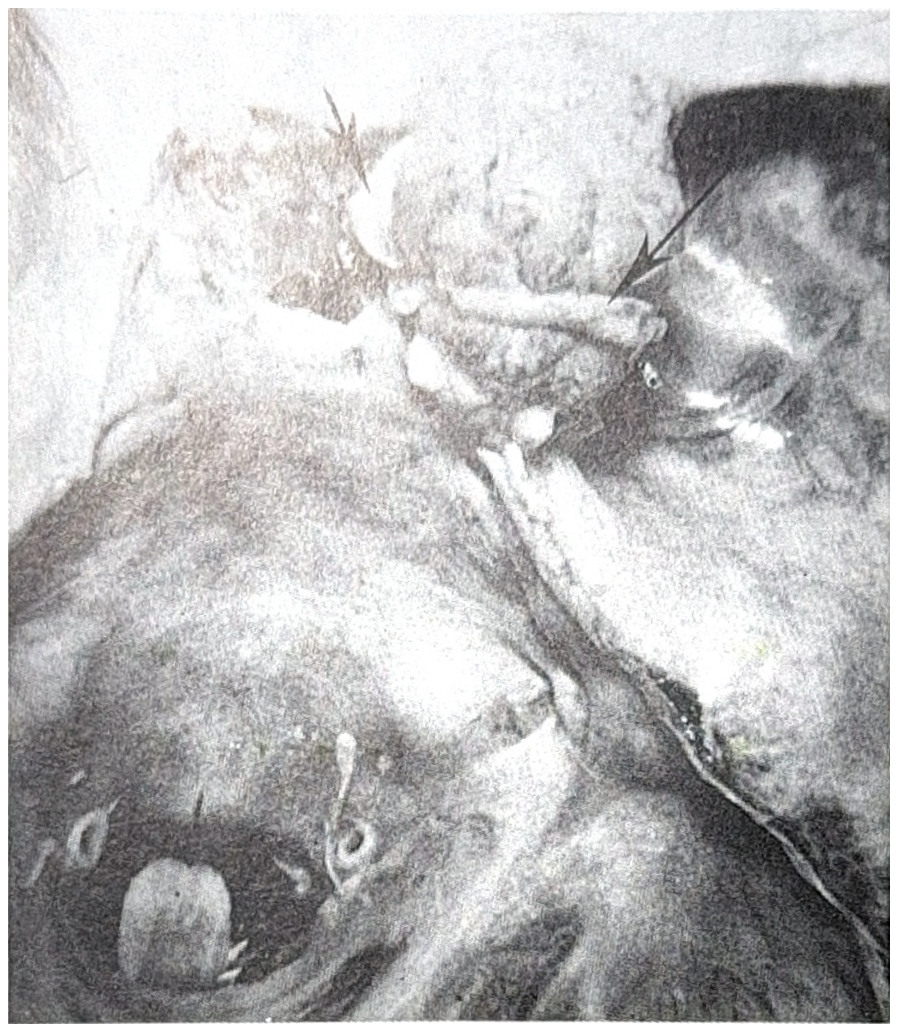 รูปที่ 3.77 แสดงถึง medial lesser wing meningioma ข้างขวากดเบียด optic nerve (ลูกศรสั้น) internal carotid artery (มองไม่เห็น) และ middle cerebral a. (ลูกศรยาว)
