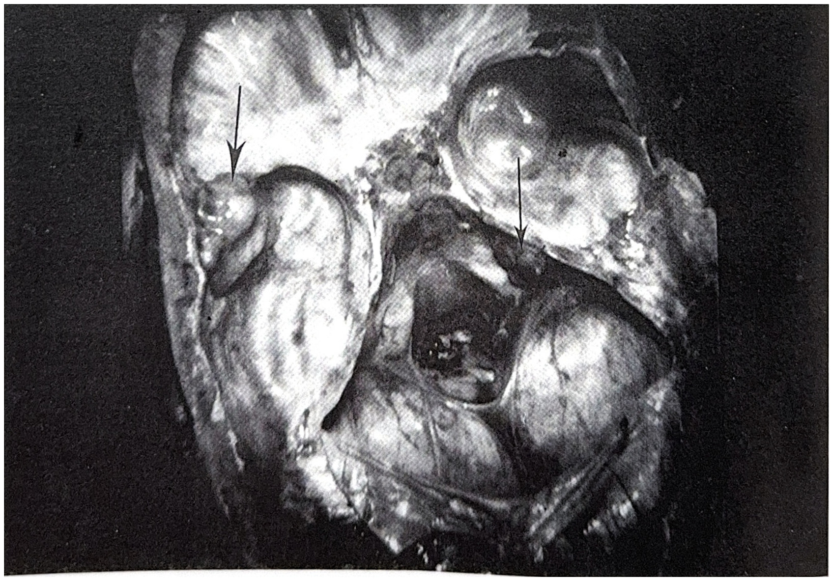 รูปที่ 3.78 แสดงถึง meningioma ที่ตำแหน่ง lesser wing ของกระดูก sphenoid ด้านข้าง 1/3 (ลูกศรใหญ่) และที่ตำแหน่งกระดูก petrous ridge (ลูกศรเล็ก)