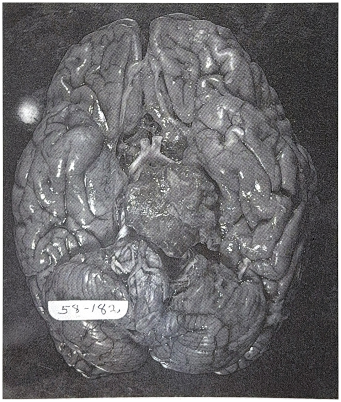 รูปที่ 3.79 แสดงถึง meningioma บริเวณ clivus ขนาดใหญ่กดลงบน brain stem และ cranial nerves สังเกตว่า brain stem ถูกเบียดไปทางด้านซ้าย