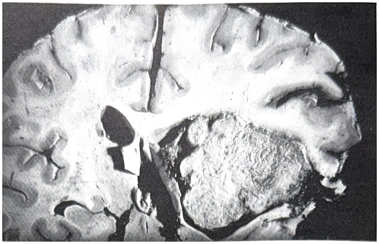 รูปที่ 3.80 แสดงถึง intraventricular meningioma บริเวณ temporal horn ซีกขวา เนื้องอกมีขอบเขตชัดเจน