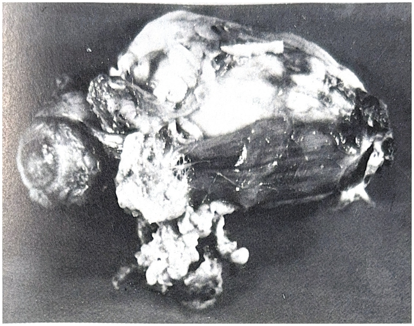 รูปที่ 3.82 แสดงถึง intraorbital meningioma เป็นสาเหตุให้มีอาการแสดง unilateral exophthalmos