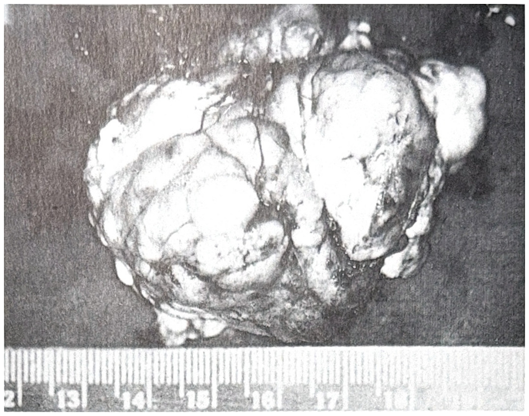 รูปที่ 3.83 เป็นภาพก้อนเนื้องอกชนิด meningioma ได้จากการผ่าตัด เนื้องอกมีลักษณะเป็นก้อนที่มีขอบเขตชัดเจน และเป็นปุ่มหลายปุ่มด้านหนึ่งของเนื้องอกจะติดกับ dura mater เสมอ