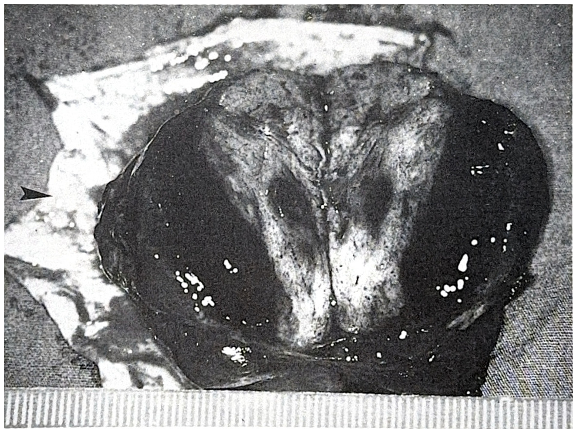 รูปที่ 3.84 ภาพเนื้องอกชนิด meningioma ได้จากการผ่าตัด แสดงถึงเลือดออกภายในก้อนเนื้องอก ในภาพเห็นเนื้องอกติดกับแผ่น dura (ลูกศร)