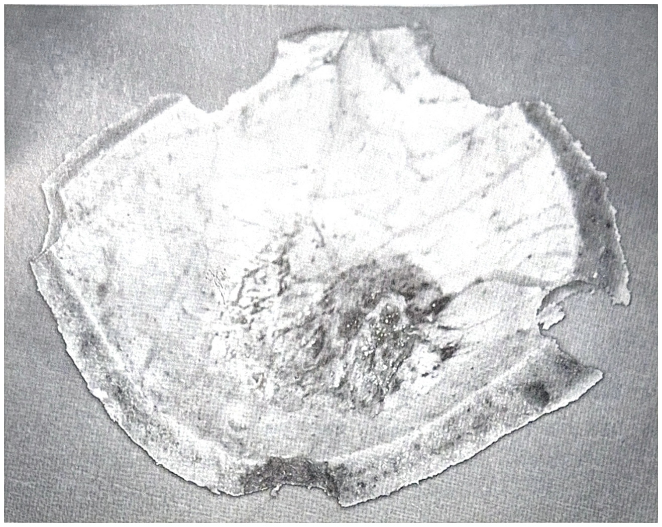 รูปที่ 3.86 แสดงถึง hyperostosis เฉพาะที่ ตรงตำแหน่งที่มีเนื้องอกติดกับ dura กระดูกจะยื่นลึกเข้าไปในผิวของก้อนเนื้องอก