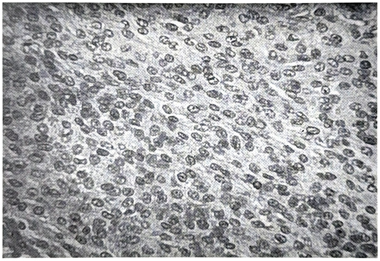 รูปที่ 3.87 แสดงถึง meningotheliomatous meningioma