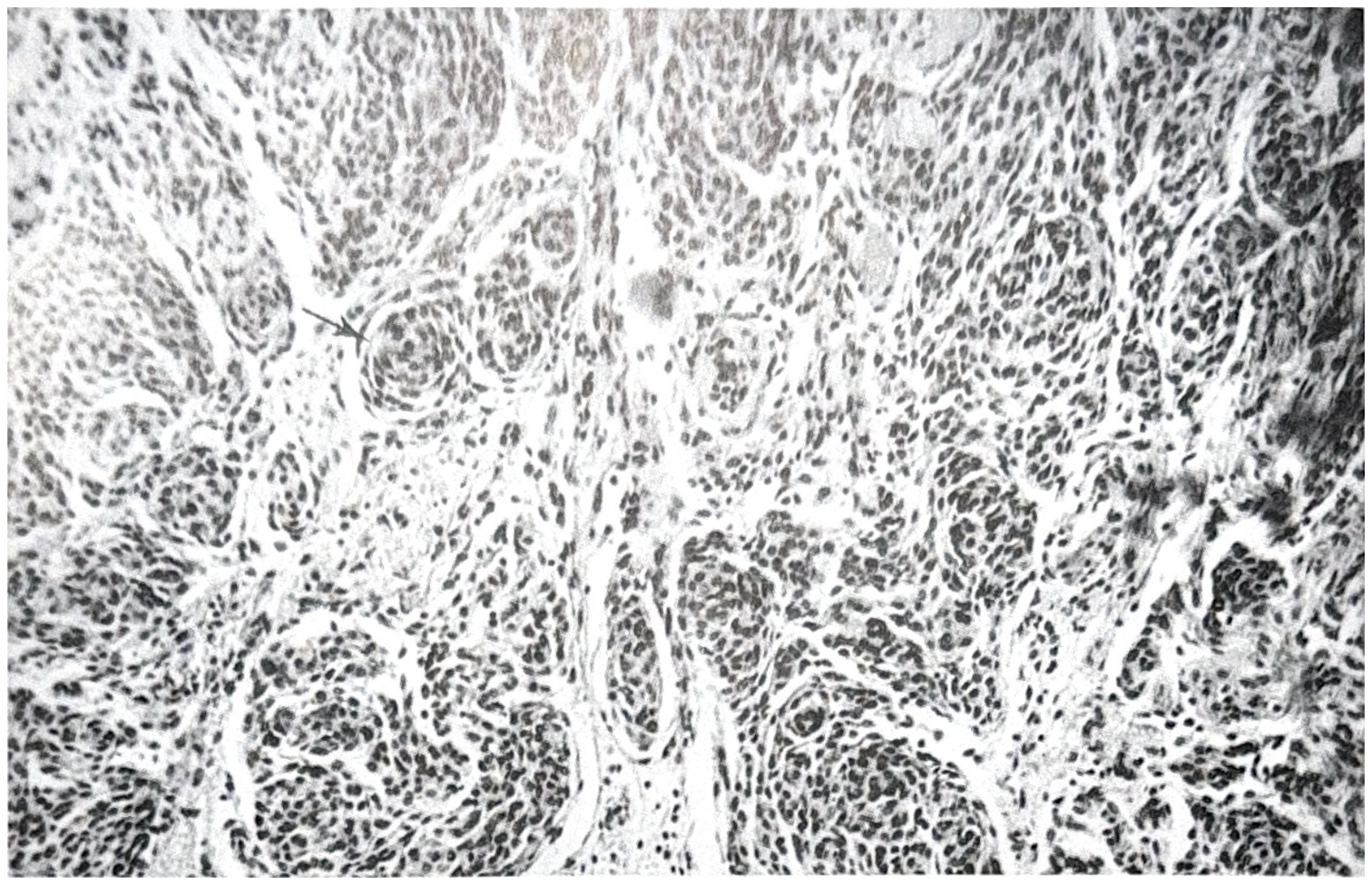 รูปที่ 3.88 ก. แสดงถึง transitional meningioma ประกอบด้วยเซลล์รูปร่างยาวรีโค้ง จับกลุ่มเป็นวง (whorl) ซึ่งเป็นลักษณะเด่นเฉพาะของ meningioma ชนิดนี้ (ลูกศร)