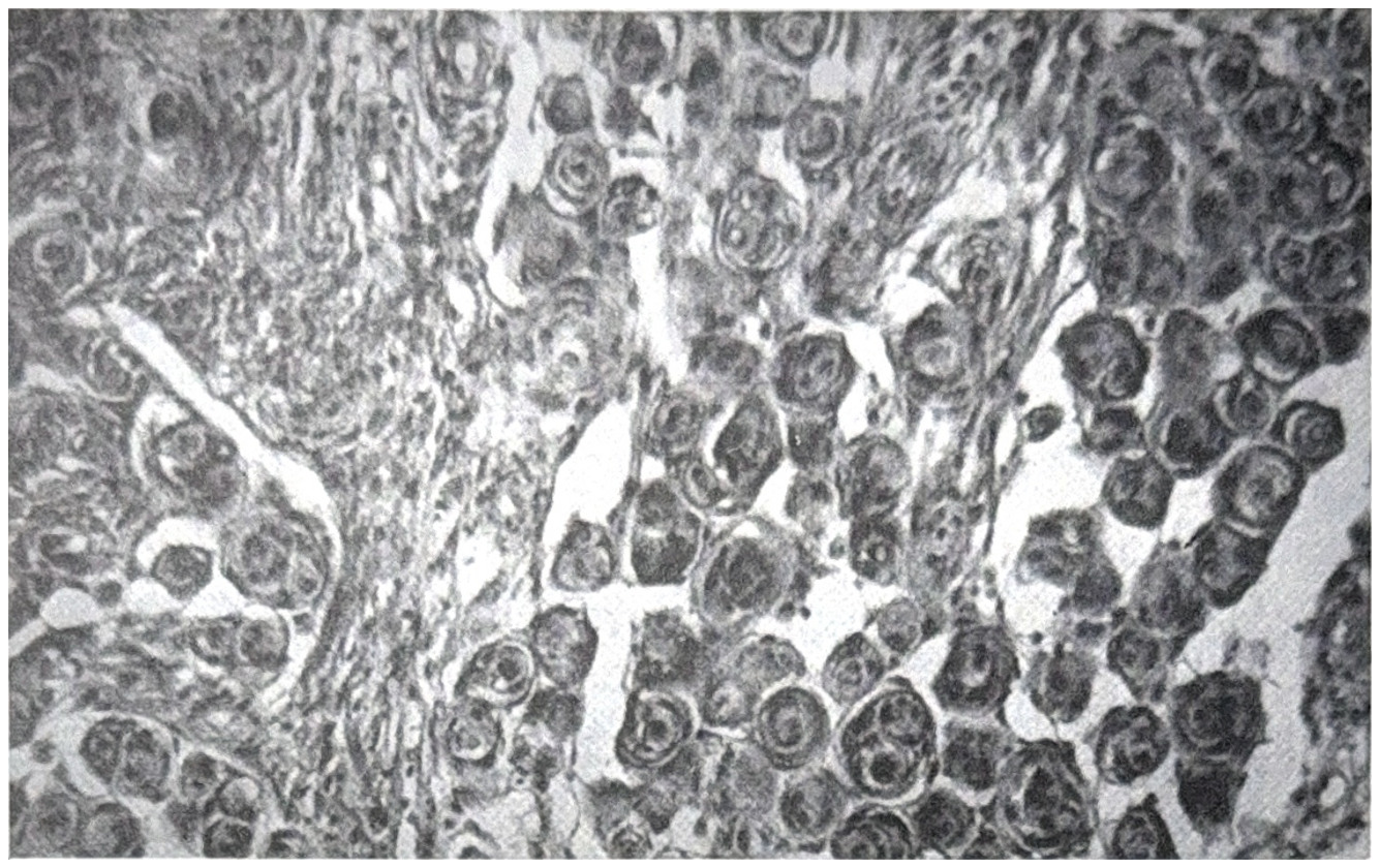 รูปที่ 3.89 แสดงถึงลักษณะเฉพาะของ psammoma bodies ภายใน psammomatous meningioma