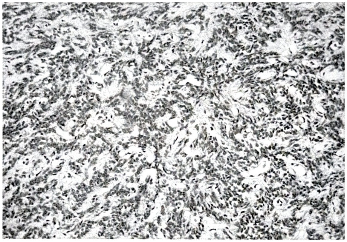 รูปที่ 3.91 ก. แสดงถึง angioblastic meningioma ประกอบด้วยหลอดเลือดฝอยผนังบางแทรกอยู่ระหว่างเซลล์เนื้องอก (H & E)