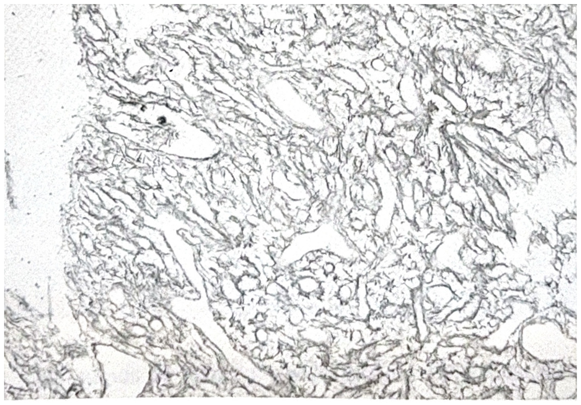 รูปที่ 3.91 ข. angioblastic meningioma ย้อมสีให้เห็น reticulin fibres