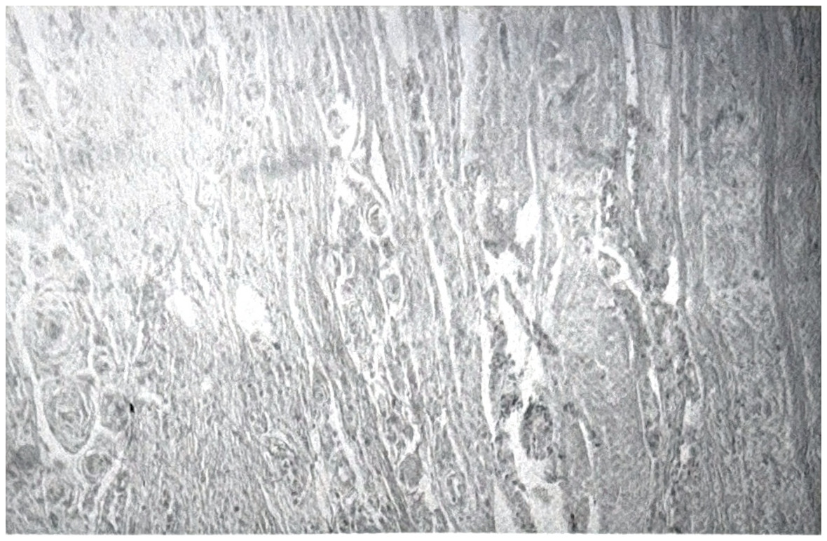 รูปที่ 3.92 แสดงให้เห็น psammomatous meningioma แผ่ขยายเข้าไปสู่ dura mater
