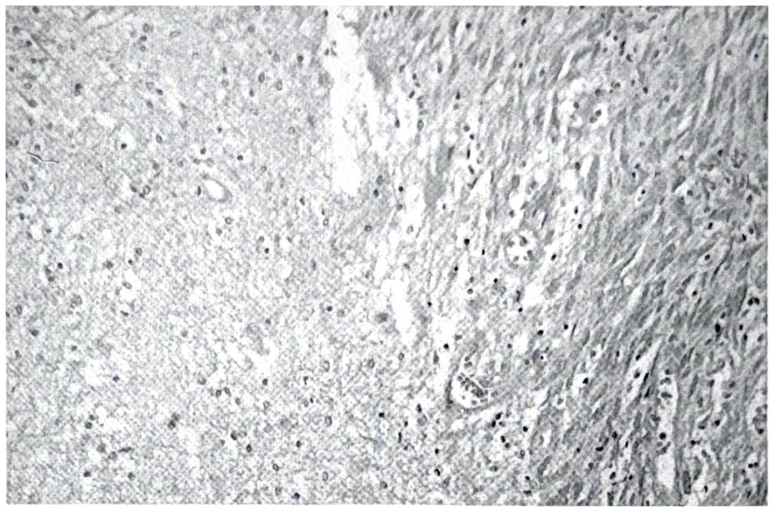 รูปที่ 3.94 ก. แสดงถึง malignant meningioma แทรกซึมเข้าไปในเนื้อสมอง เซลล์เรียงตัวกันเช่นเดียวกับ fibromatous type meningioma