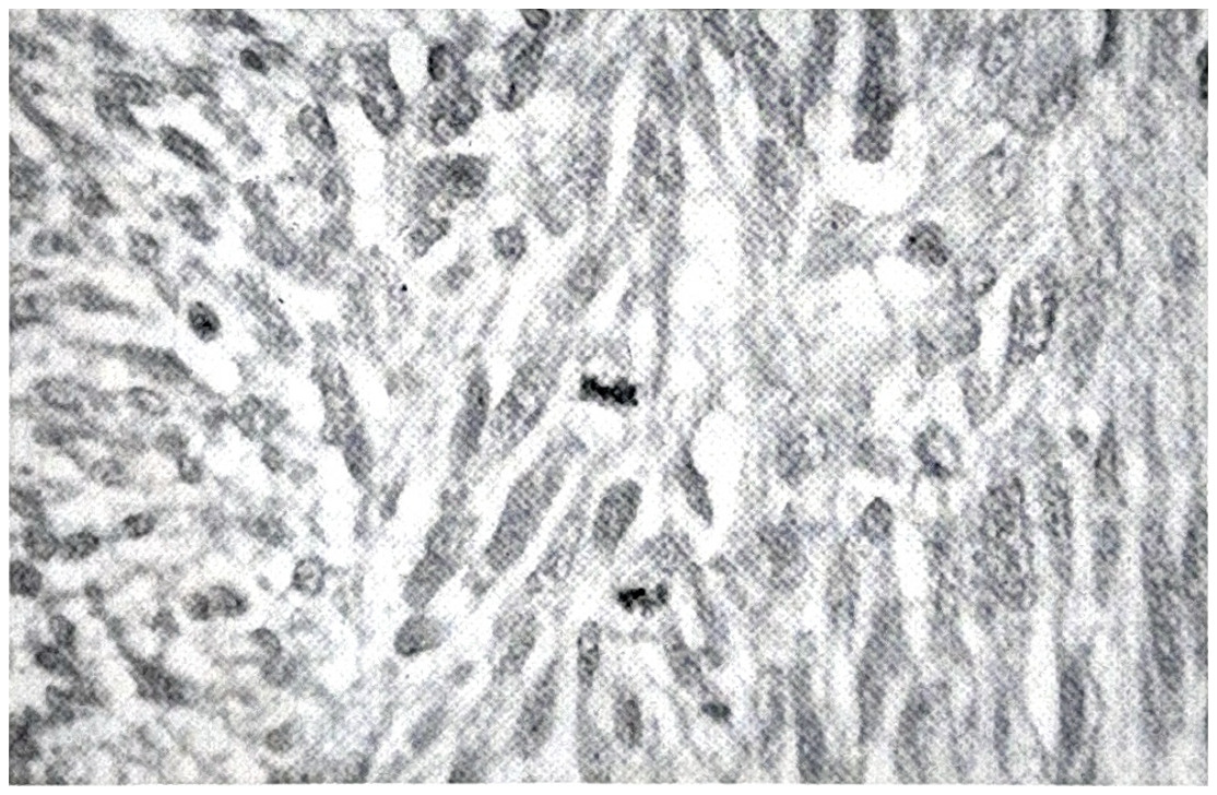 รูปที่ 3.94 ข. ภาพขยายให้เห็นความเป็นเนื้อร้าย โดยมี mitoses ของเซลล์มากมาย