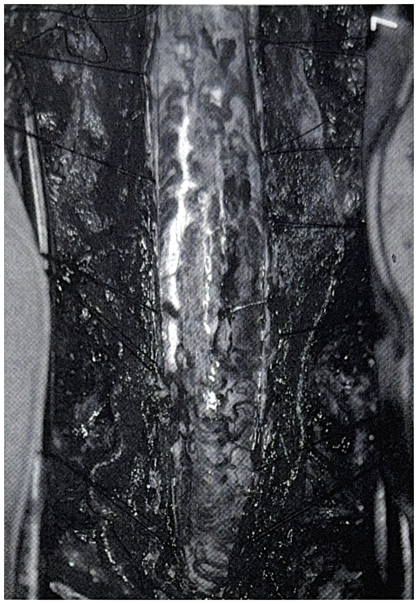 รูปที่ 3.95 แสดงถึง cervical hemangioblastoma ในผู้ป่วยที่มี cerebellar hemangioblastoma