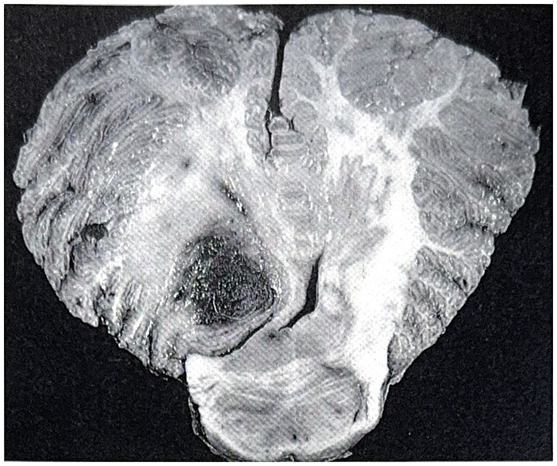 รูปที่ 3.96 แสดงถึง cerebellar hemangioblastoma มีตำแหน่งใกล้กับแนวกลาง สังเกตเห็นมีเลือดออกอยู่ภายในเนื้องอก