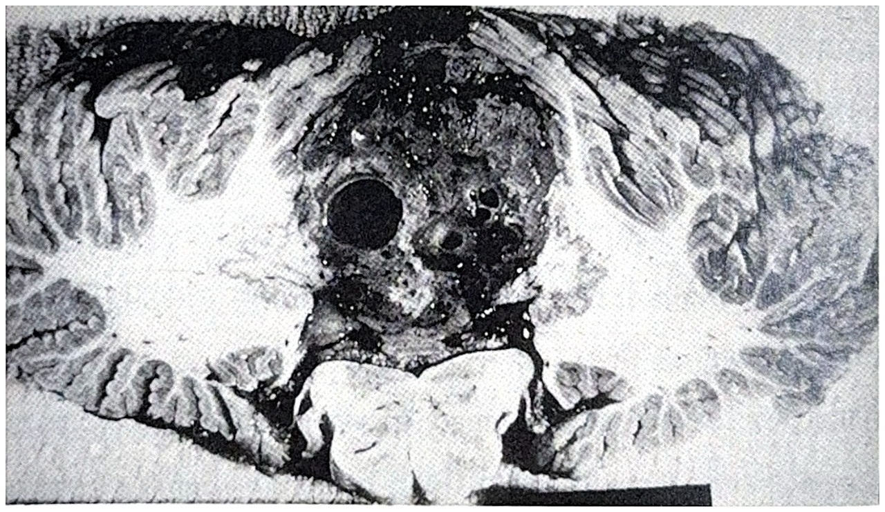 รูปที่ 3.97 แสดงถึง hemangioblastoma ในตำแหน่ง vermis ขยายเข้าไปสู่ 4th ventricle และมีขอบเขตชัดเจน ผิวหน้าตัดเห็นเป็นช่องว่างเล็ก ๆ คล้ายฟองน้ำ ซึ่งเป็นหลอดเลือดที่ขยายใหญ่ และ cyst บางแห่งหลอดเลือดขยายใหญ่มากมีลักษณะเป็น cavernous space เห็นสีเหลือง ๆ ของไขมันแทรกระหว่างหลอดเลือดซึ่งเป็นลักษณะของเนื้องอกชนิดนี้