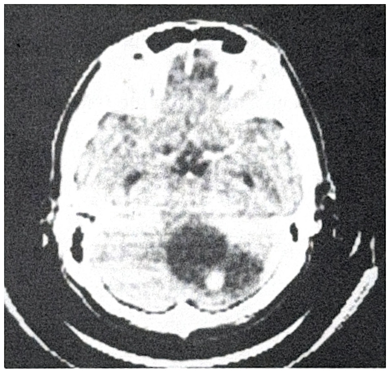 รูปที่ 3.98 ก. แสดงถึง cerebellar hemangioblastoma ชนิดที่เป็น cyst ใหญ่ และ mural nodule สังเกตเห็น mural nodule อยู่ด้านหลัง
