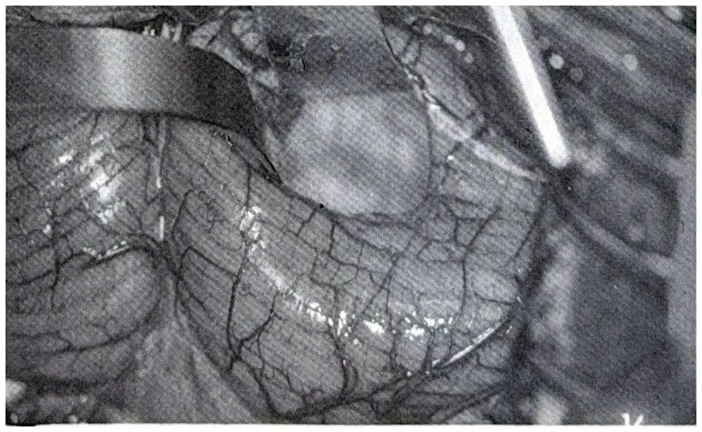 รูปที่ 3.98 ข. ภาพการผ่าตัด เห็น cyst ใหญ่ที่ cerebellar hemisphere ข้างขวา mural nodule ได้ถูกตัดออกไปแล้ว
